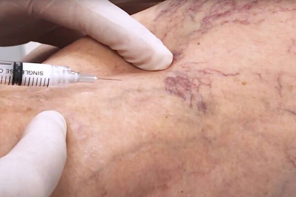 Secagem de vasinhos: a febre estética que virou assunto de saúde pública unnamed 2025 08 15T110538.020
