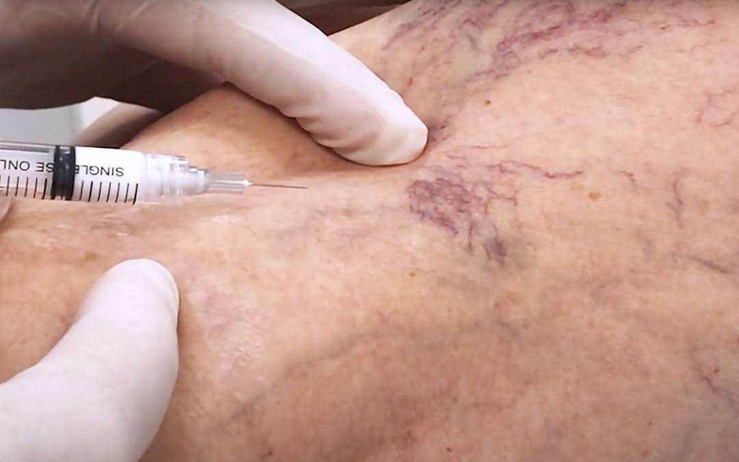 Secagem de vasinhos: a febre estética que virou assunto de saúde pública 1 unnamed 2025 08 15T110538.020